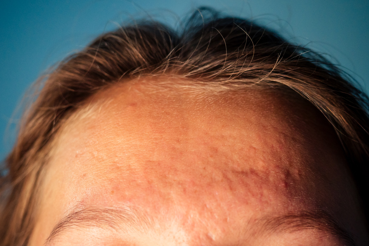 Deep Acne Scars: Prevention Tips and Treatment Guide
