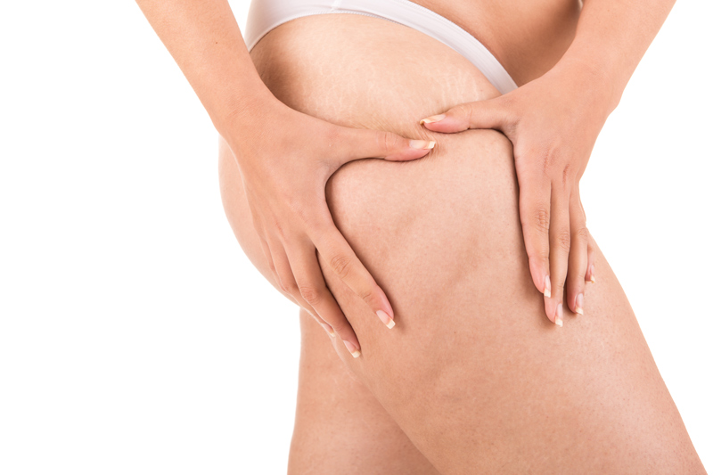 How To Get Rid Of Cellulite?