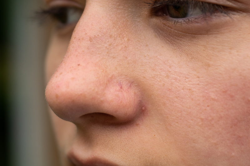 What Are The Causes Of Spider Capillaries On The Face?