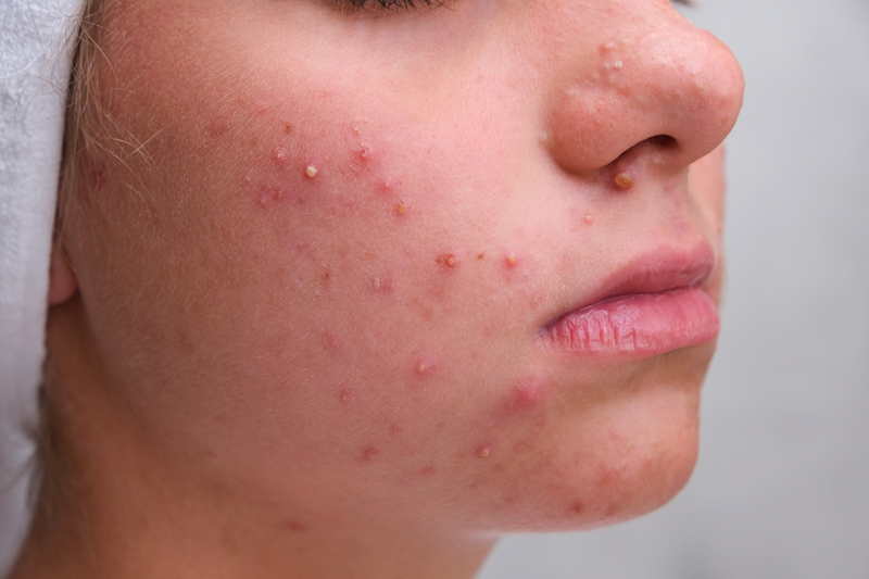 Suffering From Acne? 5 Methods To Get Healthy Skin 