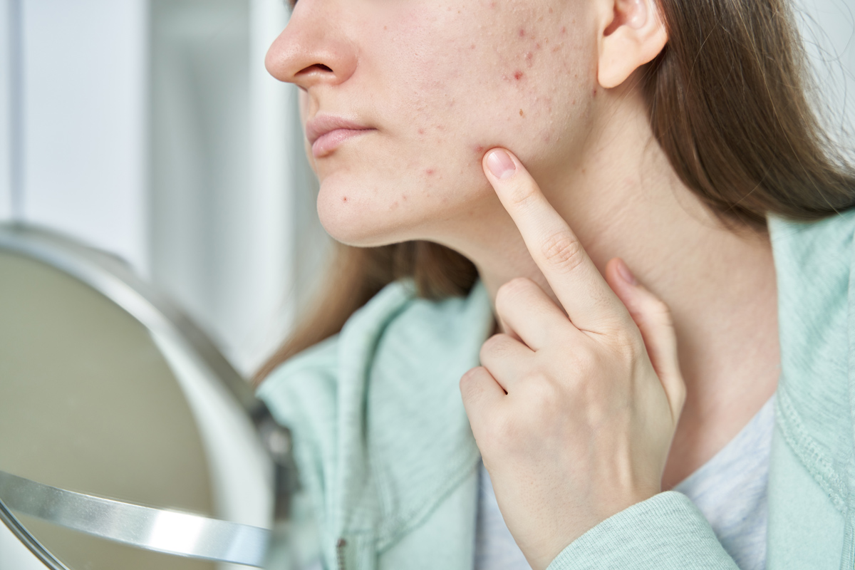 Can I Get Rid Of Acne Forever?