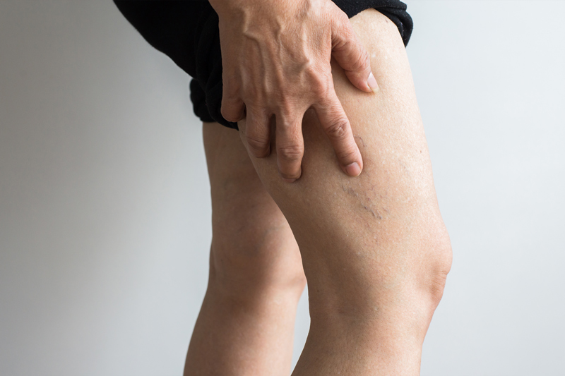 Are Spider Veins a Health Issue?